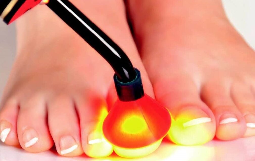 Laser treatment of the nail plate