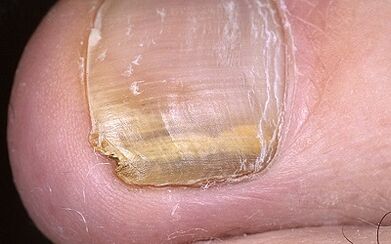 Mushroom demonstrations on the thumb of the leg
