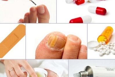 How to treat fungi on the nails