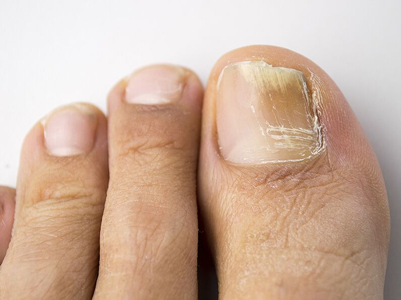 The initial mushroom stage