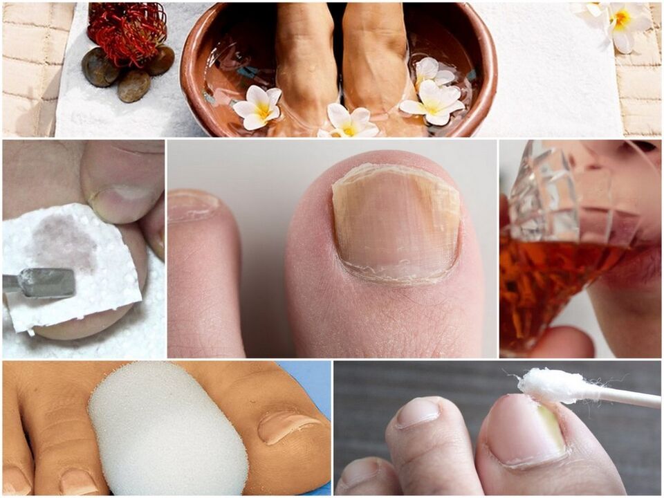 Treatment of nail fungi