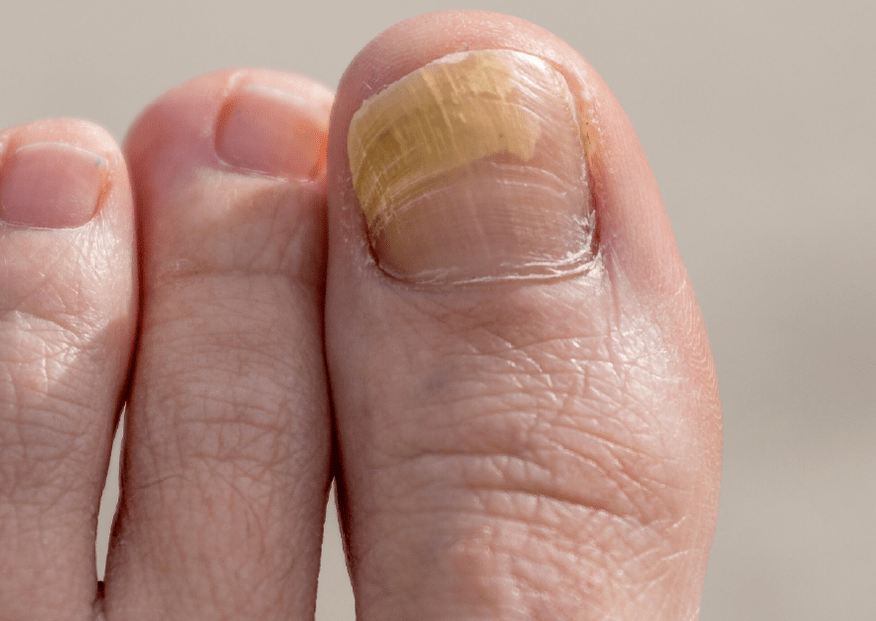 fungus on the nail of the big toe